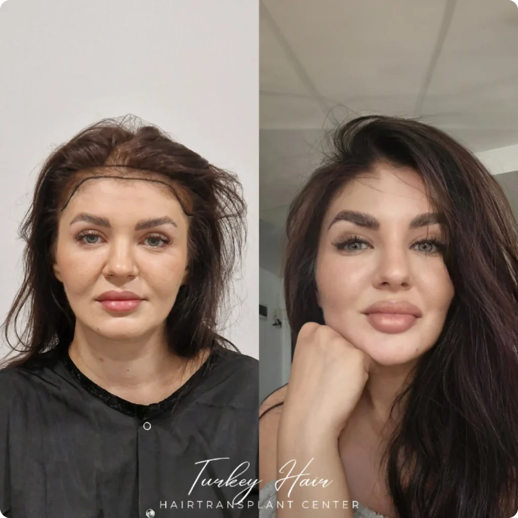 Hair Transplant Final Natural Result