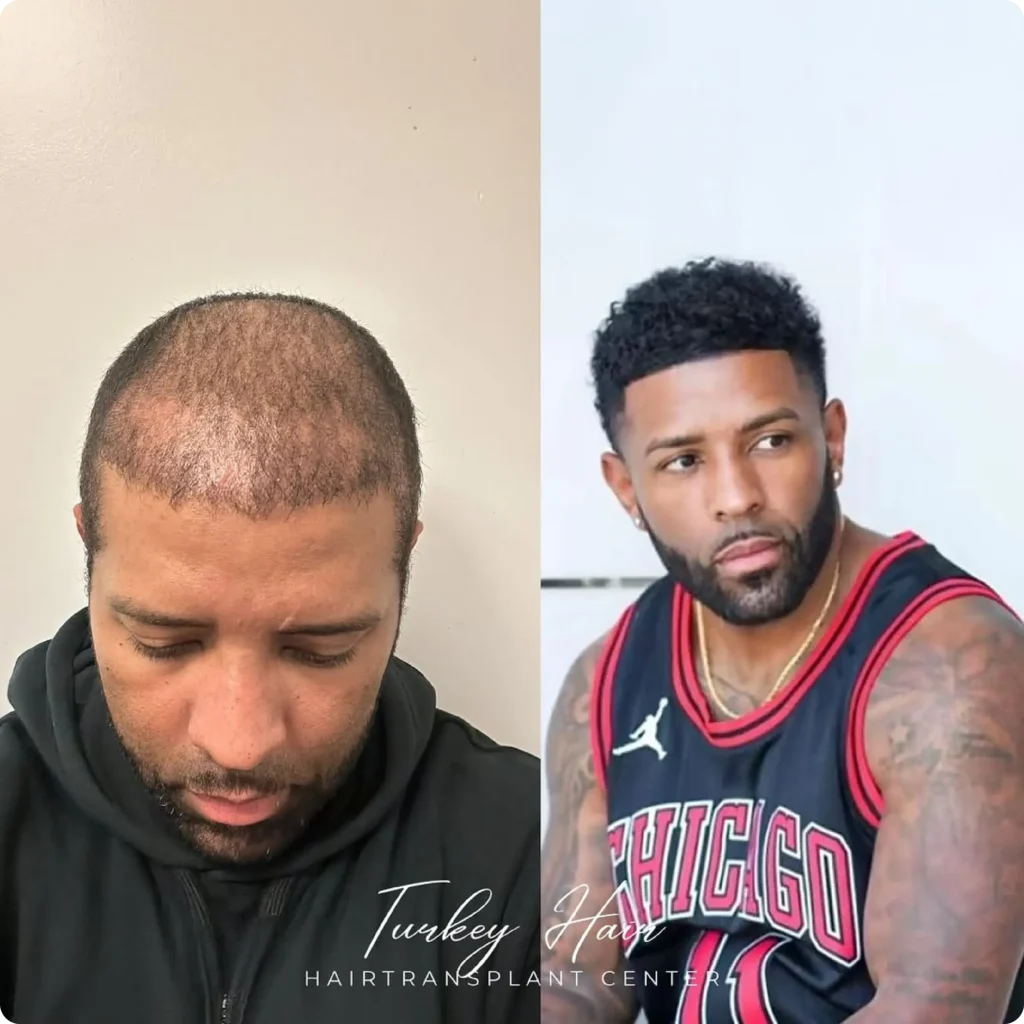 Hair Transplant Procedure Result