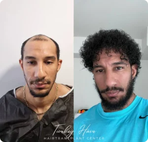 Before & After Hair Restoration Excellence You Can Trust