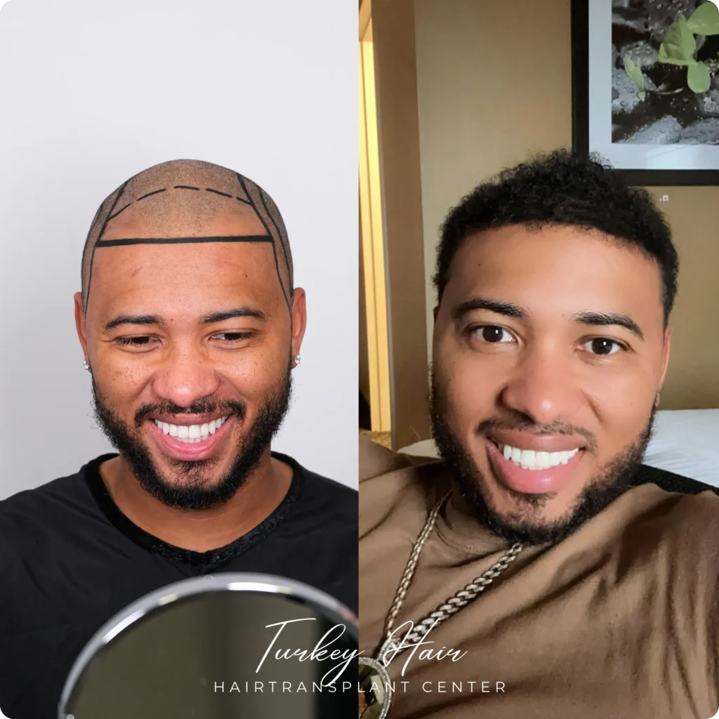 Résultat naturel de la greffe de cheveux afro