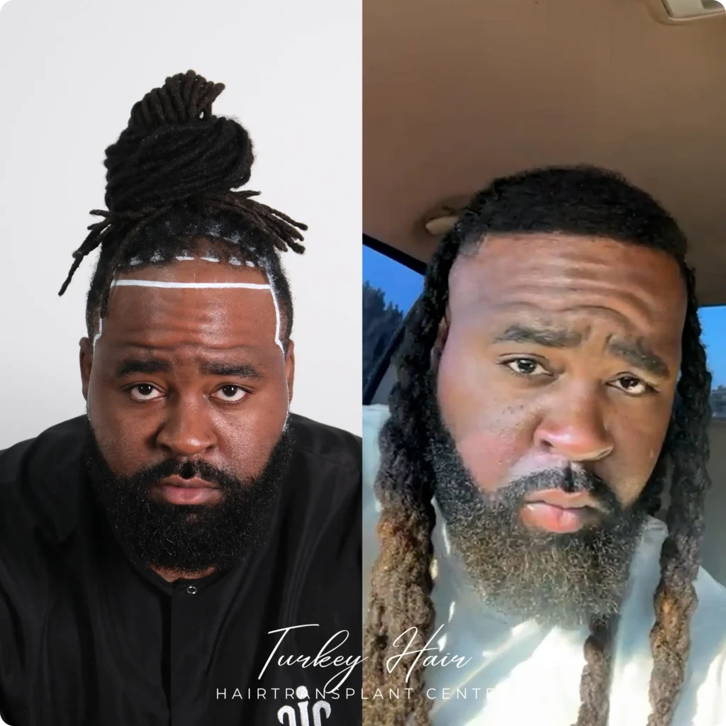 Direct Hair Implantation Technique Result