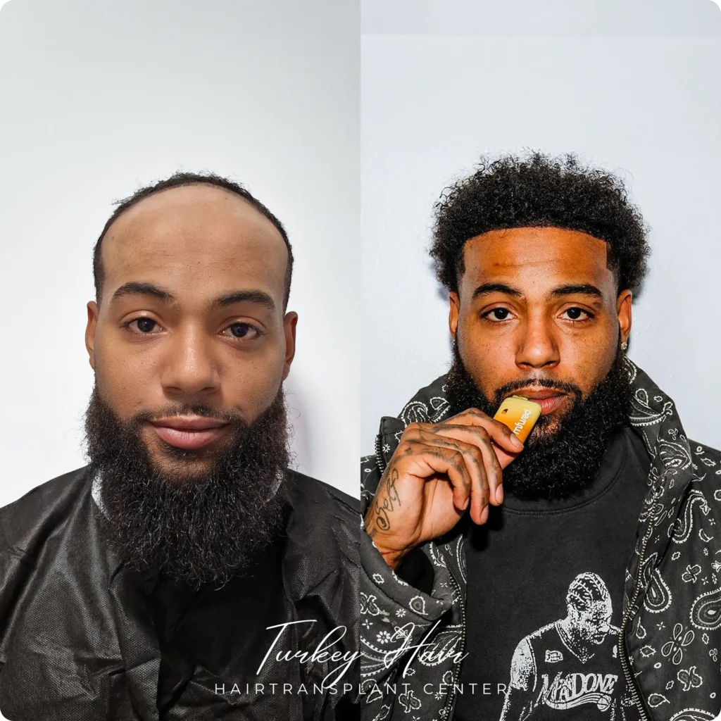Natural Looking Hair Transplant Outcome