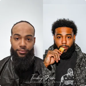 Before & After Hair Restoration Excellence You Can Trust