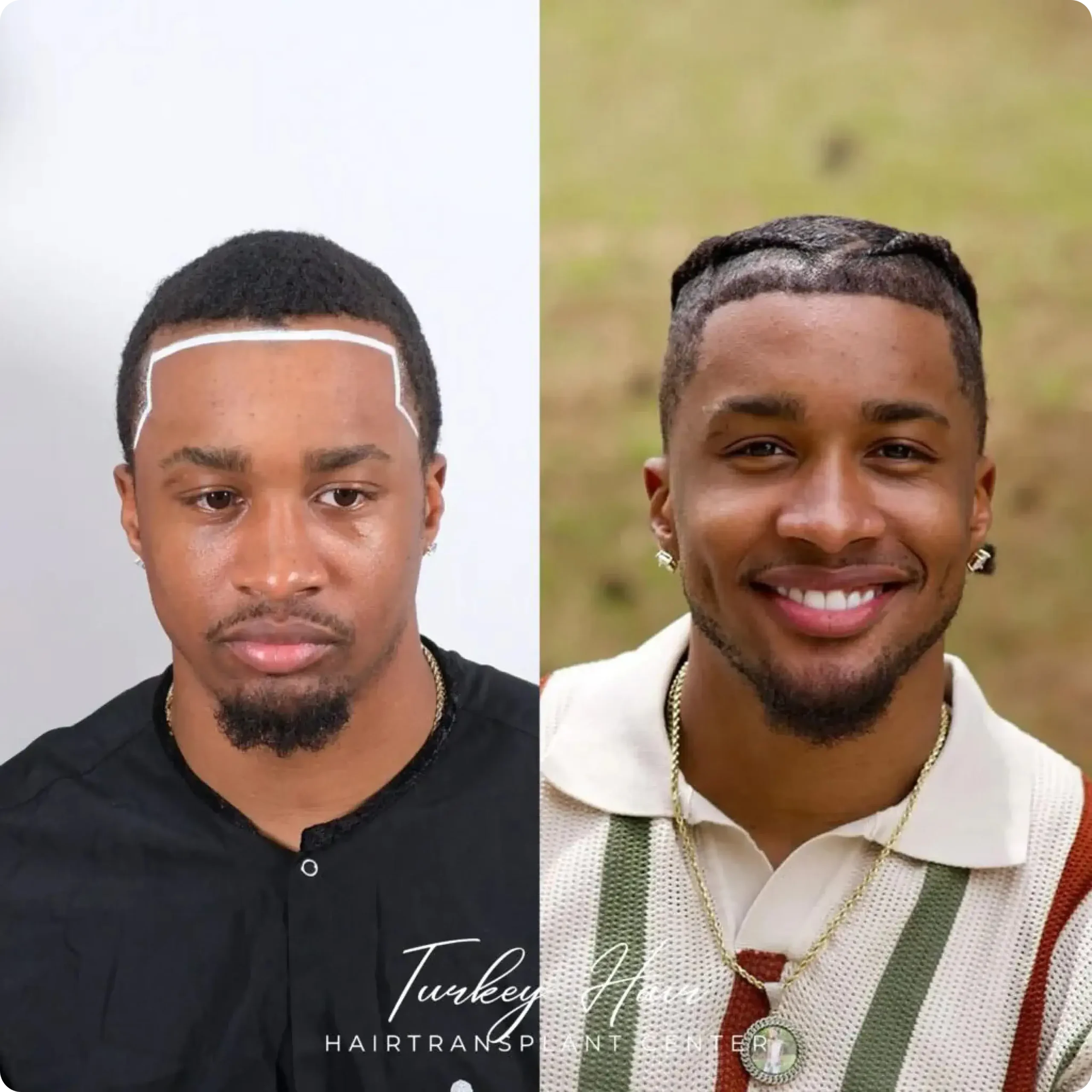 Professional Afro Hair Transplant Result