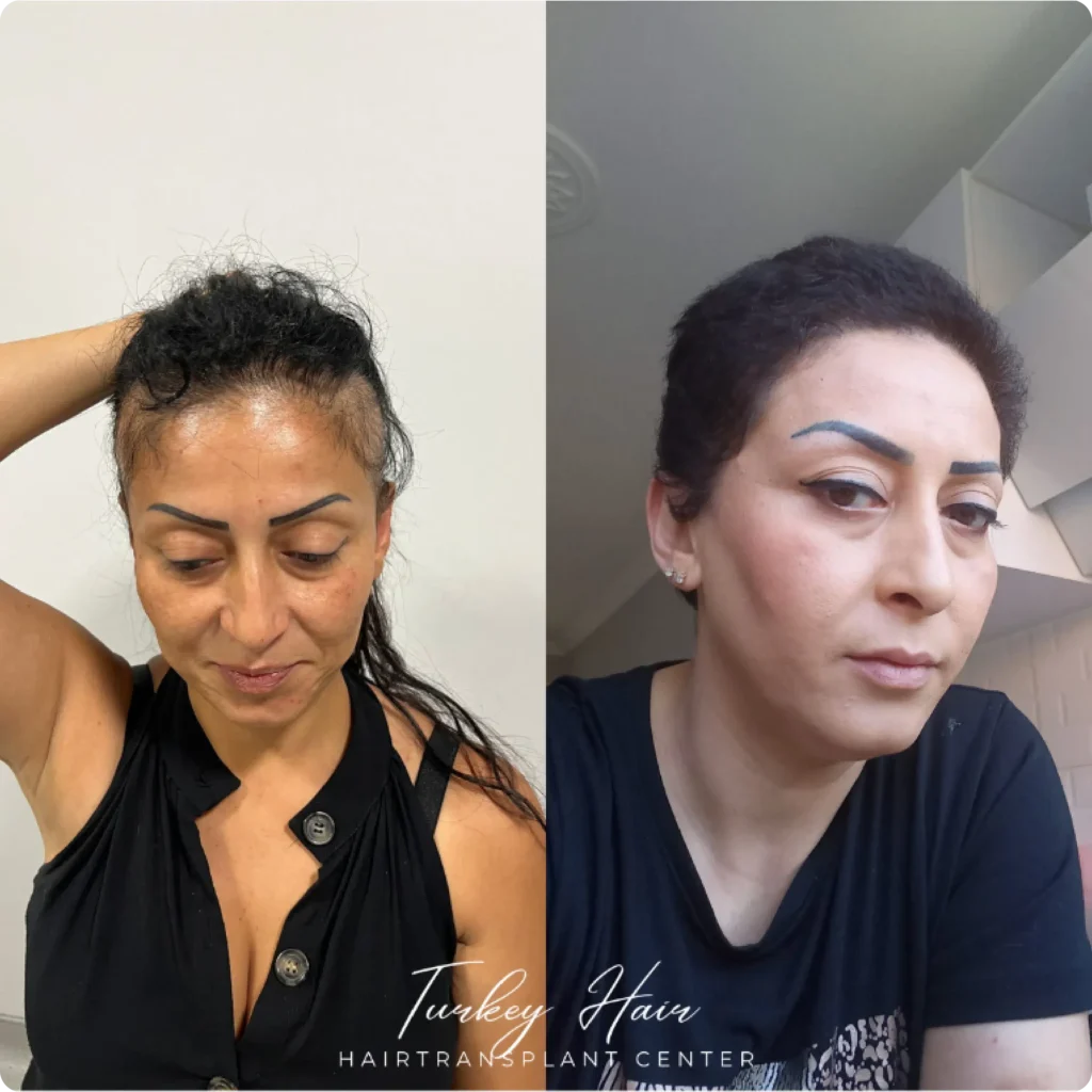 Transformation de greffe de cheveux féminins avec naissance des cheveux naturelle, volume et croissance saine des cheveux