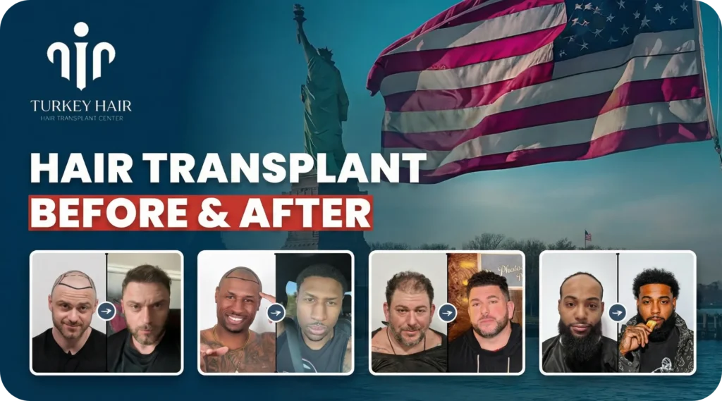 Turkey Hair Transplant Before - After