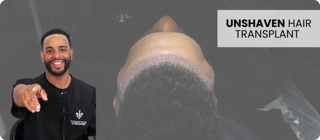 Unshaven Hair Transplants No Shave Hair Transplants