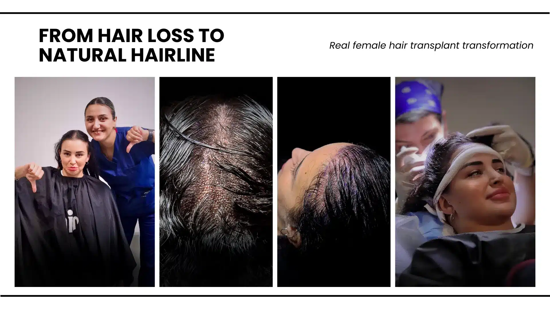 Greffe de cheveux féminins à Côte d'Ivoire hair transplant analysis