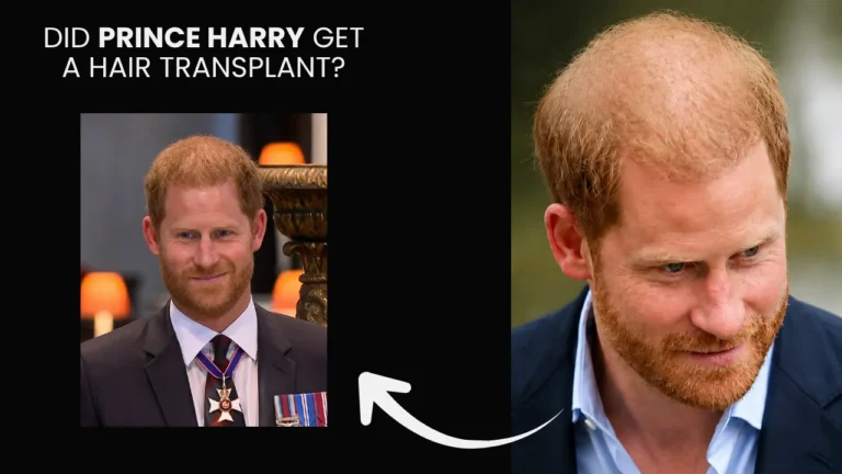 Prince Harry Hair Transplant Comparison Image Showing Visible Crown Thinning And Hair Density Changes Over Time.