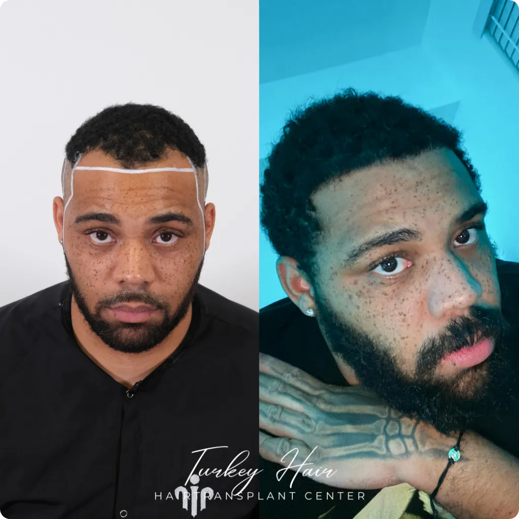 Afro Hair Transplant Before And After: 17 Real 12-Month Results &Amp; Expert Analysis 2 Afro Hair Transplant Before And After: 17 Real 12-Month Results &Amp; Expert Analysis Hair Restoration Excellence You Can Trust