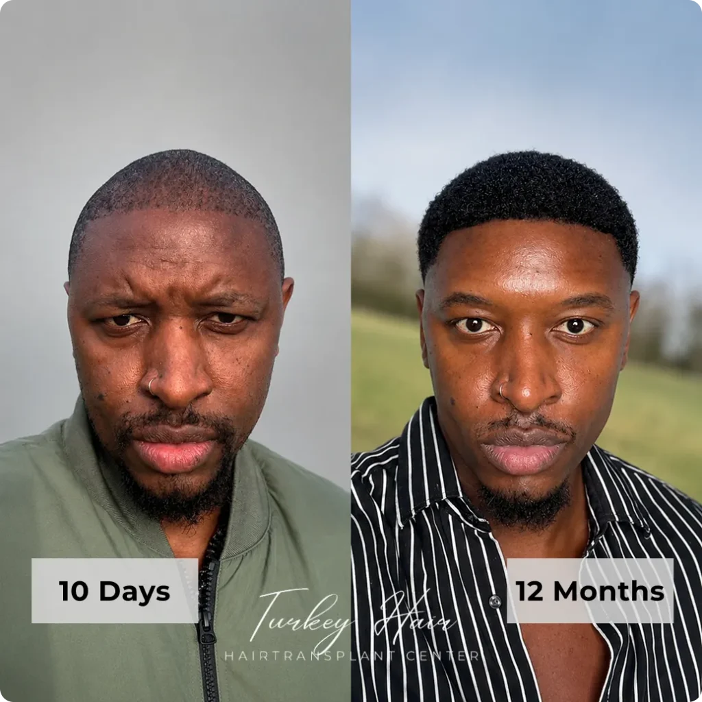 Afro Hair Transplant Before And After: 17 Real 12-Month Results &Amp; Expert Analysis 3 Afro Hair Transplant Before And After: 17 Real 12-Month Results &Amp; Expert Analysis Hair Restoration Excellence You Can Trust