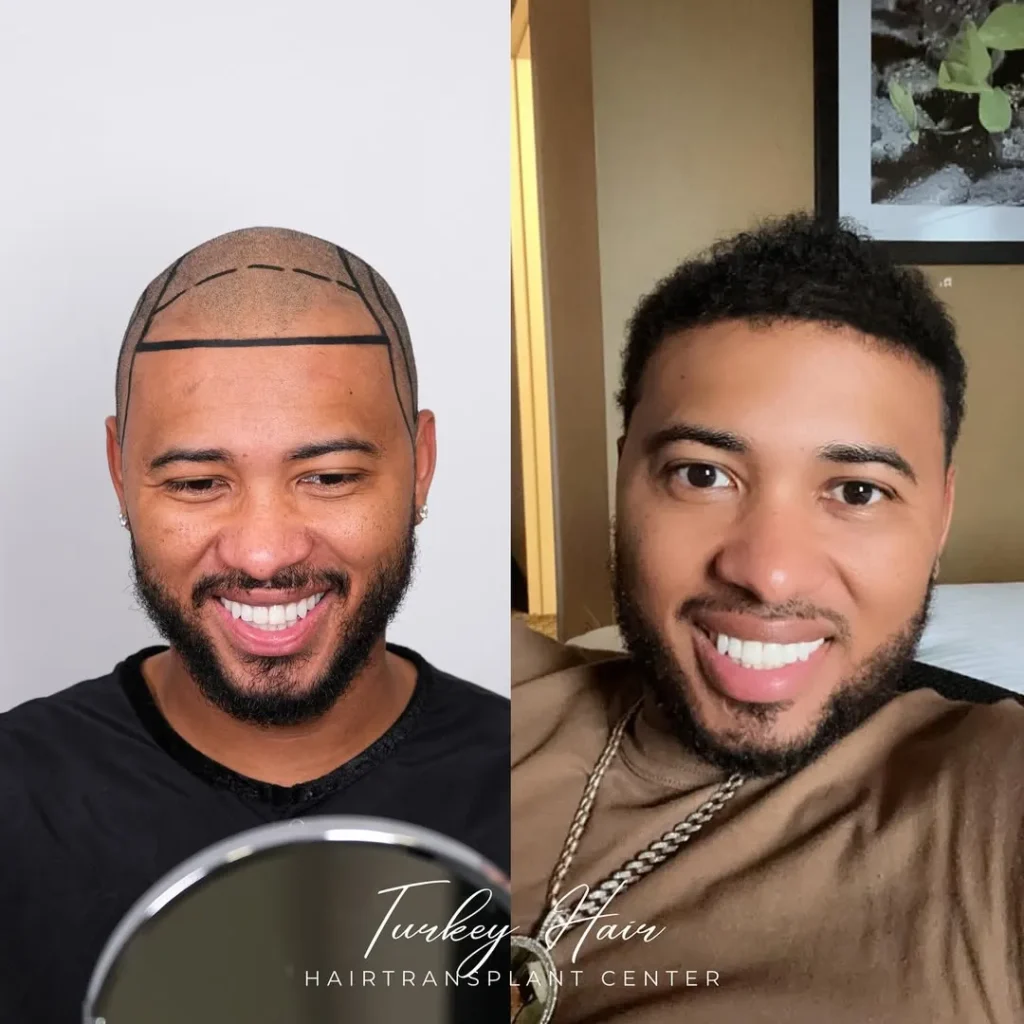 Afro Hair Transplant Before And After: 17 Real 12-Month Results &Amp; Expert Analysis 5 Afro Hair Transplant Before And After: 17 Real 12-Month Results &Amp; Expert Analysis Hair Restoration Excellence You Can Trust