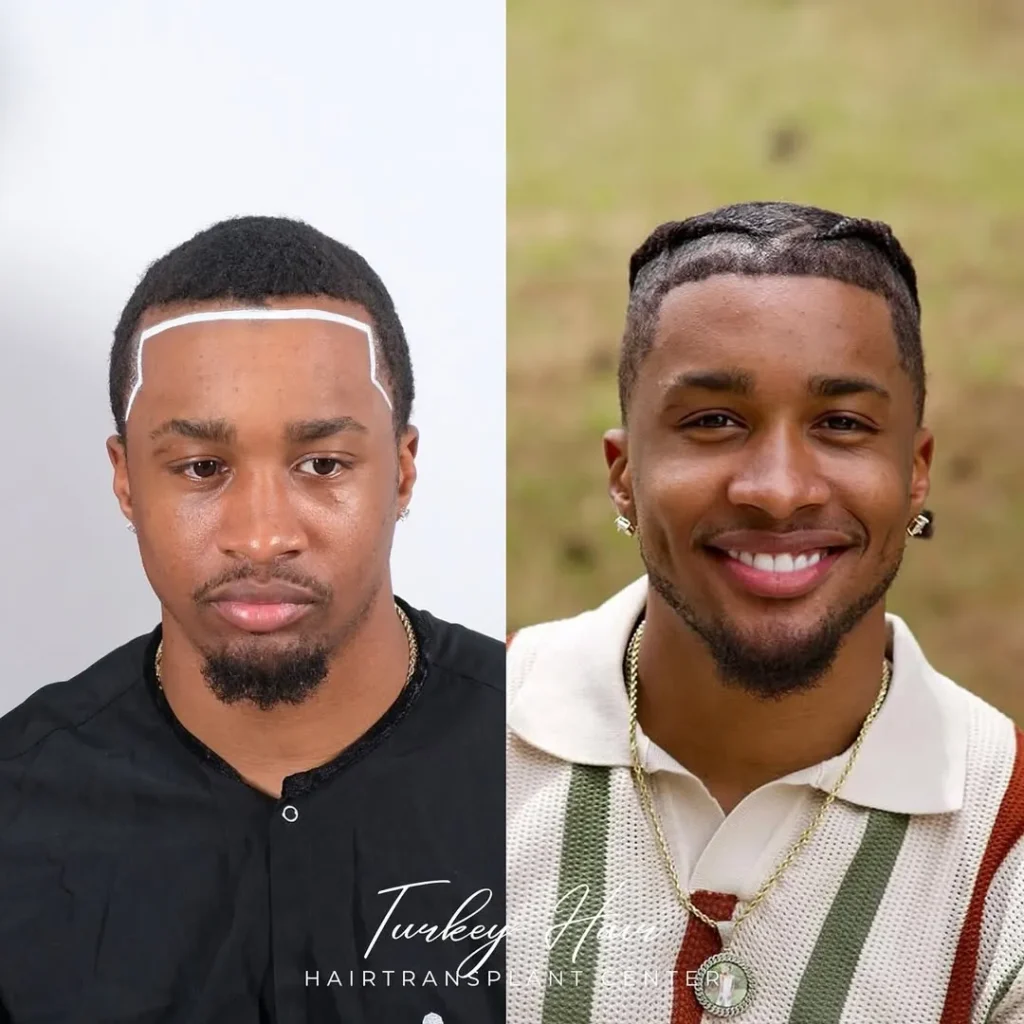 Afro Hair Transplant Before And After: 17 Real 12-Month Results &Amp; Expert Analysis 7 Afro Hair Transplant Before And After: 17 Real 12-Month Results &Amp; Expert Analysis Hair Restoration Excellence You Can Trust