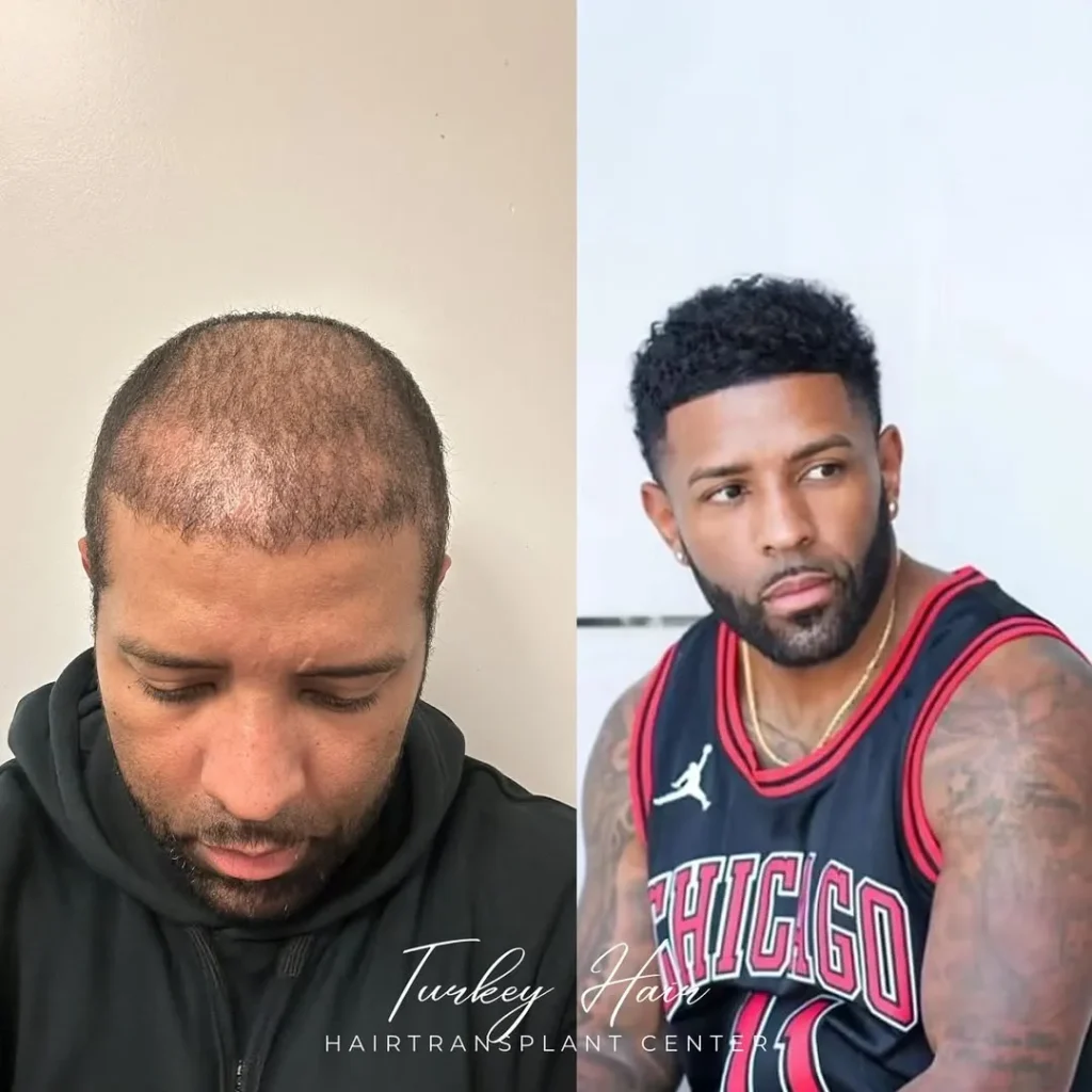 Afro Hair Transplant Before And After: 17 Real 12-Month Results &Amp; Expert Analysis 6 Afro Hair Transplant Before And After: 17 Real 12-Month Results &Amp; Expert Analysis Hair Restoration Excellence You Can Trust