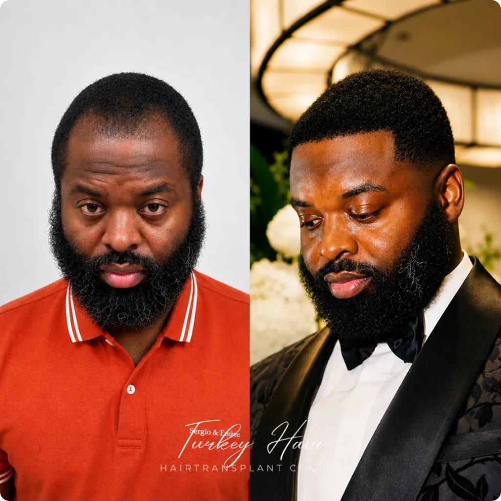 Afro Hair Transplant Before And After: 17 Real 12-Month Results &Amp; Expert Analysis 12 Afro Hair Transplant Before And After: 17 Real 12-Month Results &Amp; Expert Analysis Hair Restoration Excellence You Can Trust