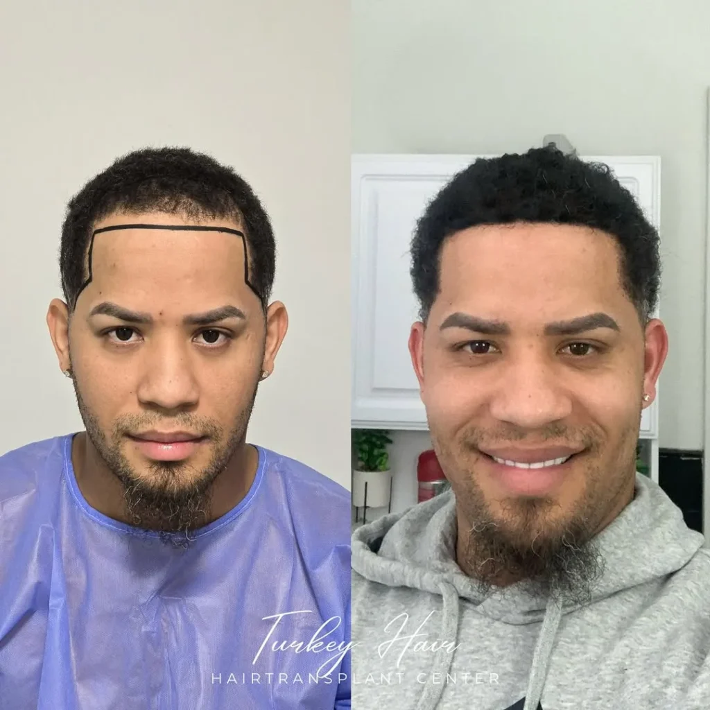 Afro Hair Transplant Before And After: 17 Real 12-Month Results &Amp; Expert Analysis 10 Afro Hair Transplant Before And After: 17 Real 12-Month Results &Amp; Expert Analysis Hair Restoration Excellence You Can Trust