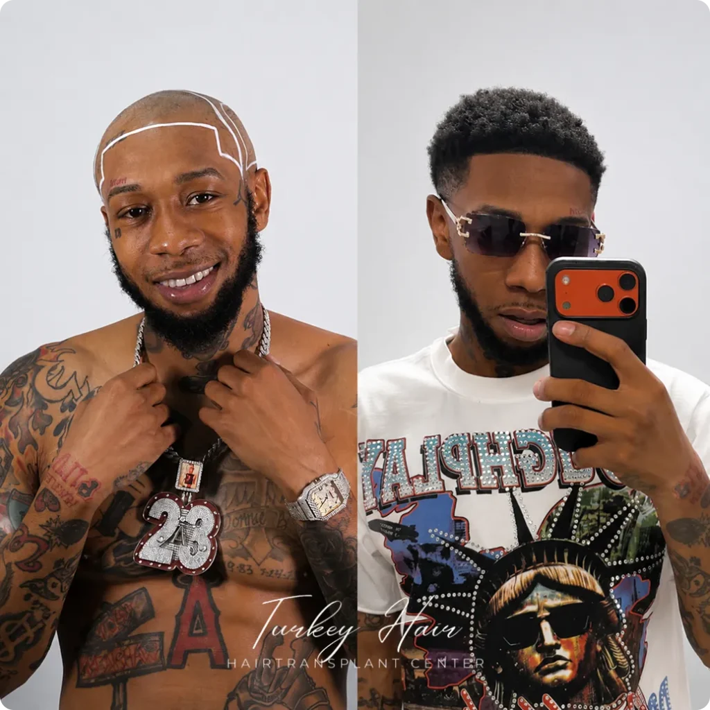 Afro Hair Transplant Before And After: 17 Real 12-Month Results &Amp; Expert Analysis 9 Afro Hair Transplant Before And After: 17 Real 12-Month Results &Amp; Expert Analysis Hair Restoration Excellence You Can Trust