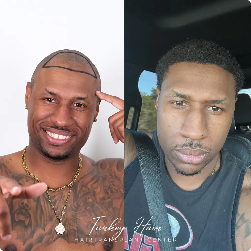 Afro Hair Transplant Before And After: 17 Real 12-Month Results &Amp; Expert Analysis 11 Afro Hair Transplant Before And After: 17 Real 12-Month Results &Amp; Expert Analysis Hair Restoration Excellence You Can Trust