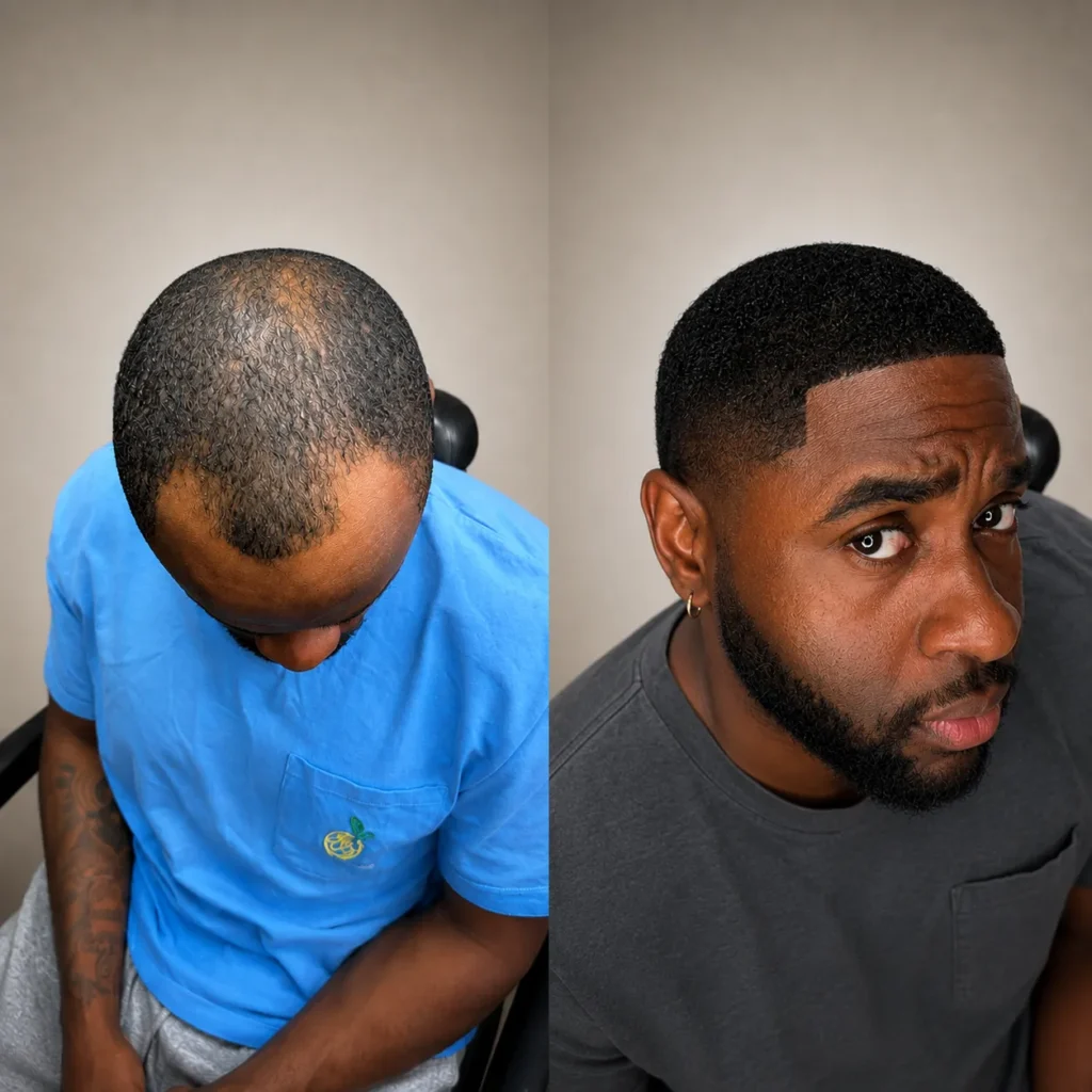 Afro Hair Transplant Before And After: 17 Real 12-Month Results &Amp; Expert Analysis 13 Afro Hair Transplant Before And After: 17 Real 12-Month Results &Amp; Expert Analysis Hair Restoration Excellence You Can Trust