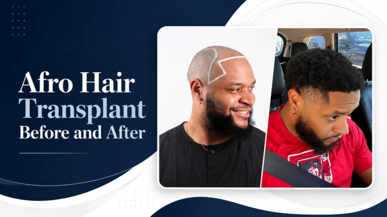 Afro Hair Transplant Before And After: 17 Real 12-Month Results &Amp;Amp; Expert Analysis 3 Afro Hair Transplant Before And After: 17 Real 12-Month Results &Amp;Amp; Expert Analysis