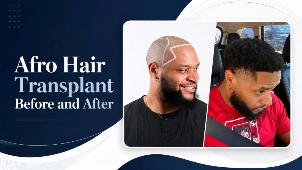 Afro Hair Transplant Before And After: 17 Real 12-Month Results &Amp; Expert Analysis 1 Afro Hair Transplant Before And After