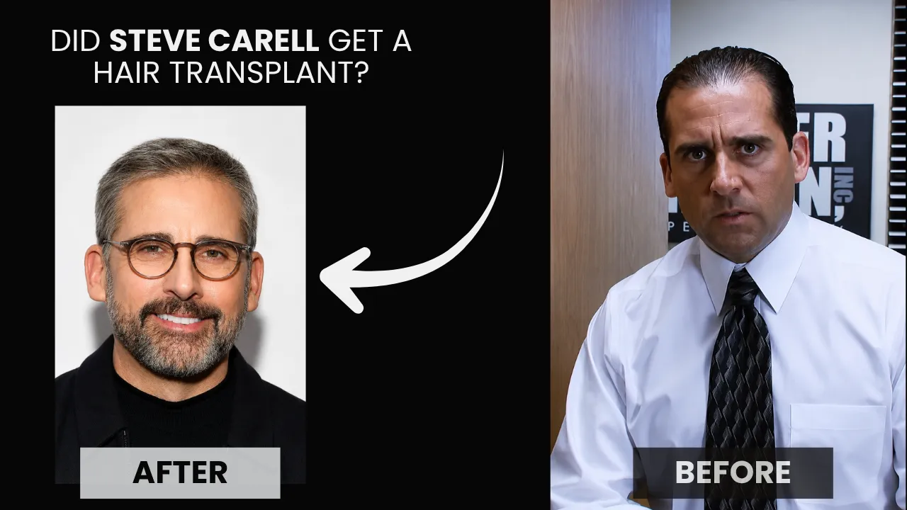 Did Steve Carell Get A Hair Transplant Before And After Did Steve Carell Get A Hair Transplant Before And After Hairline Comparison