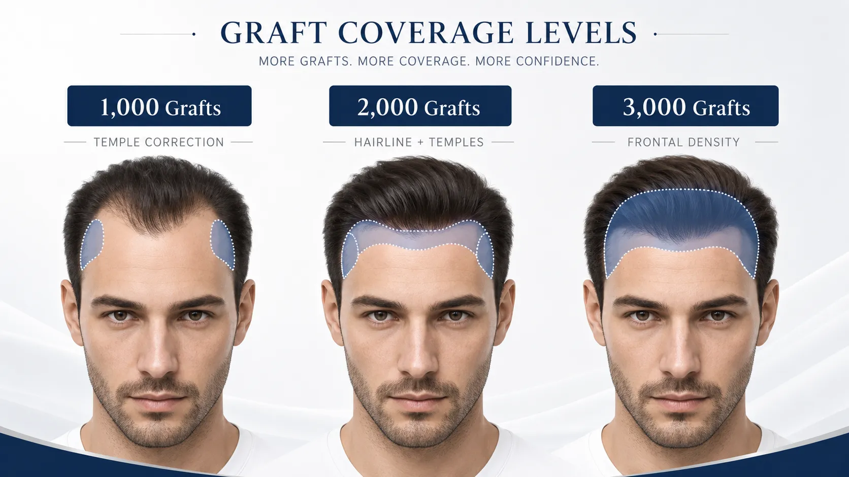 How Much Is A Hairline Transplant? Cost Guide 3 1,000 / 2,000 / 3,000 Grafts Coverage