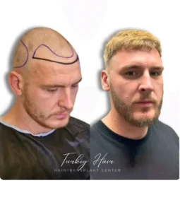 Hair Transplant Before And After Result Showing Restored Hairline And Improved Hair Density in Ethiopia