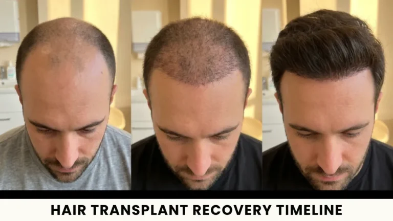 Hair Transplant Recovery Timeline: Day-By-Day, Week-By-Week And Month-By-Month Guide 5 Hair Transplant Recovery Timeline: Day-By-Day, Week-By-Week And Month-By-Month Guide