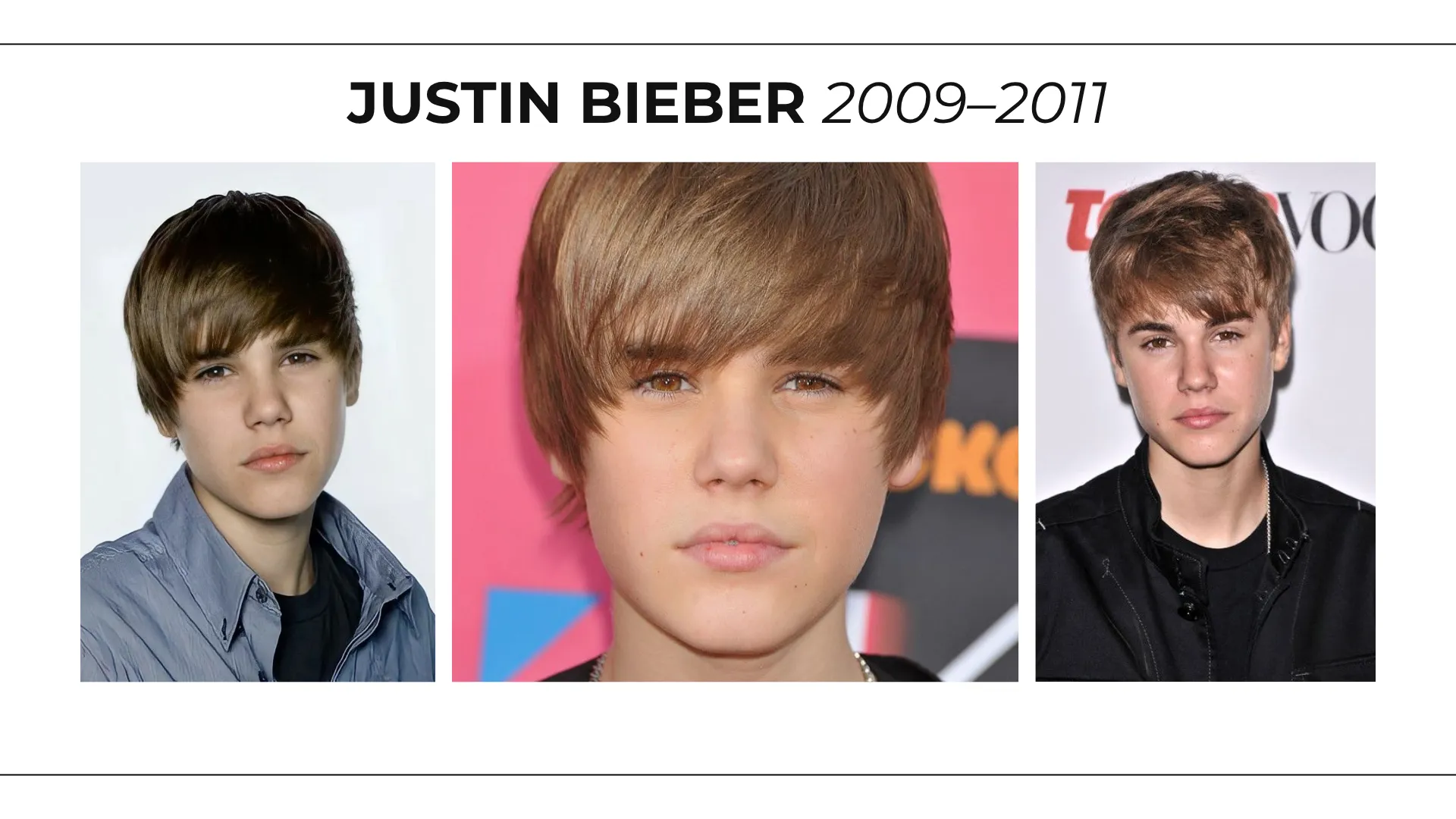 Justin Bieber Hair Transplant: Hairline Analysis, Before &Amp; After Photos, Rumors &Amp; Expert Opinion 5 Justin Bieber 2009–2011 Hairline Comparison Showing Early Hairstyle And Frontal Hair Coverage Changes