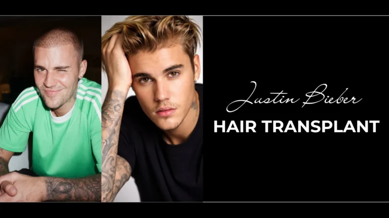 Justin Bieber Hair Transplant: Hairline Analysis, Before &Amp;Amp; After Photos, Rumors &Amp;Amp; Expert Opinion 6 Justin Bieber Hair Transplant: Hairline Analysis, Before &Amp;Amp; After Photos, Rumors &Amp;Amp; Expert Opinion