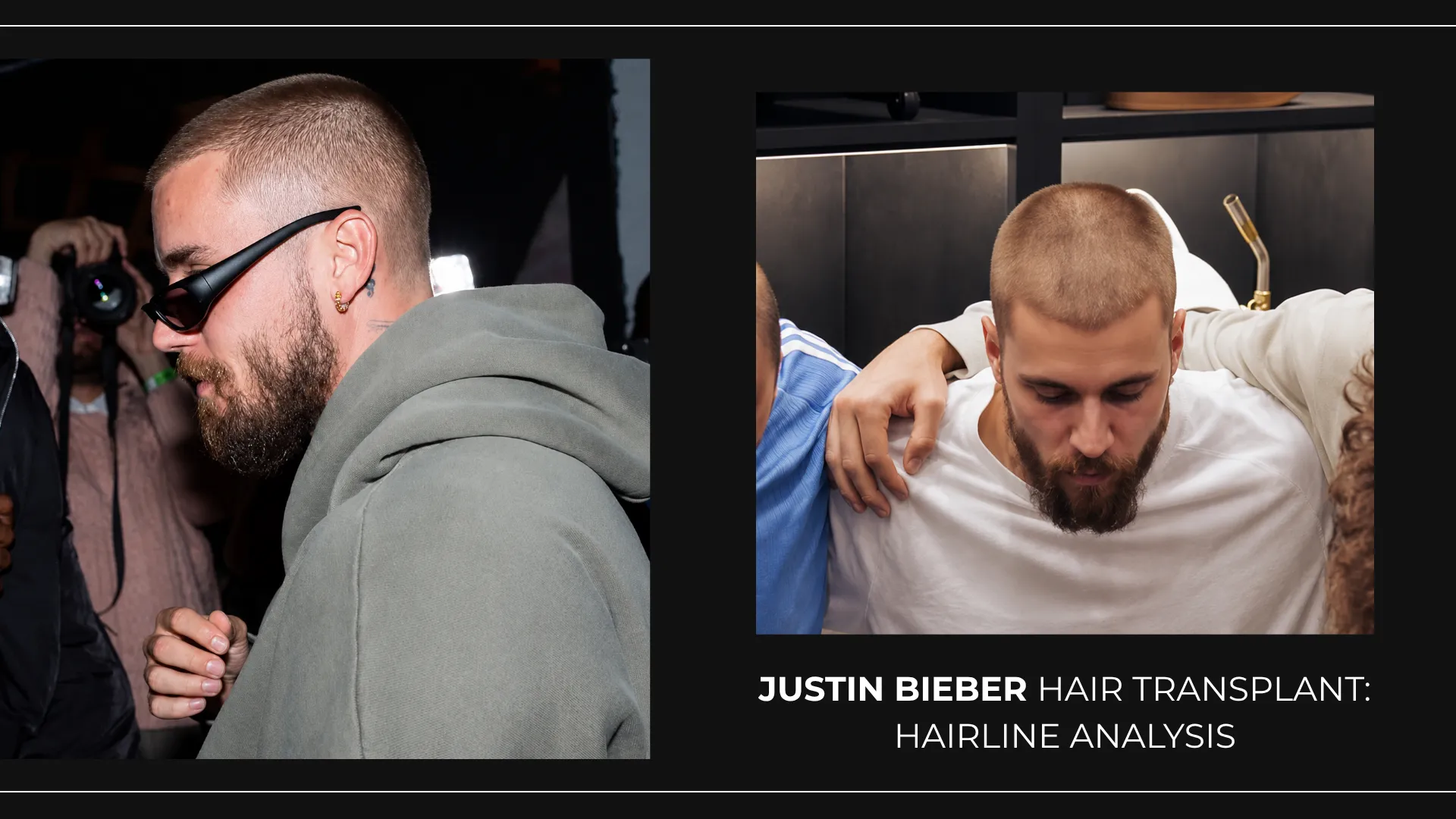 Justin Bieber Hair Transplant: Hairline Analysis, Before &Amp; After Photos, Rumors &Amp; Expert Opinion 9 Justin Bieber Hair Transplant And Hairline Analysis Showing Buzz Cut Hairstyle, Side Hair Density, And Frontal Hair Coverage