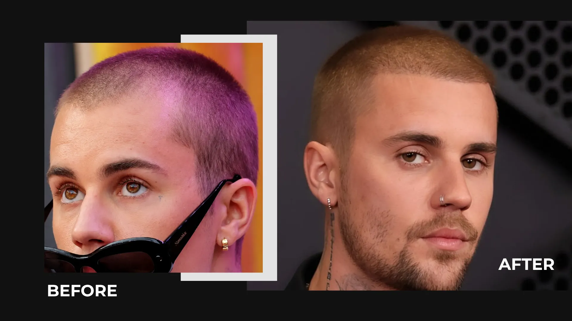 Justin Bieber Hair Transplant: Hairline Analysis, Before &Amp; After Photos, Rumors &Amp; Expert Opinion 12 Justin Bieber Before And After Buzz Cut Hairline Comparison Showing Frontal Hair Coverage, Hairline Shape, And Short Hairstyle Changes