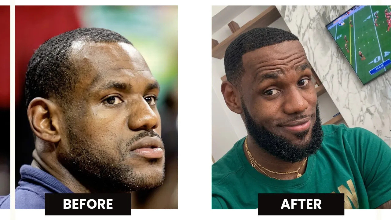 Lebron James Hair Transplant: Hairline Analysis 4 Lebron James Before And After Hairline Comparison Showing Earlier Thinning And Fuller Later Hairline