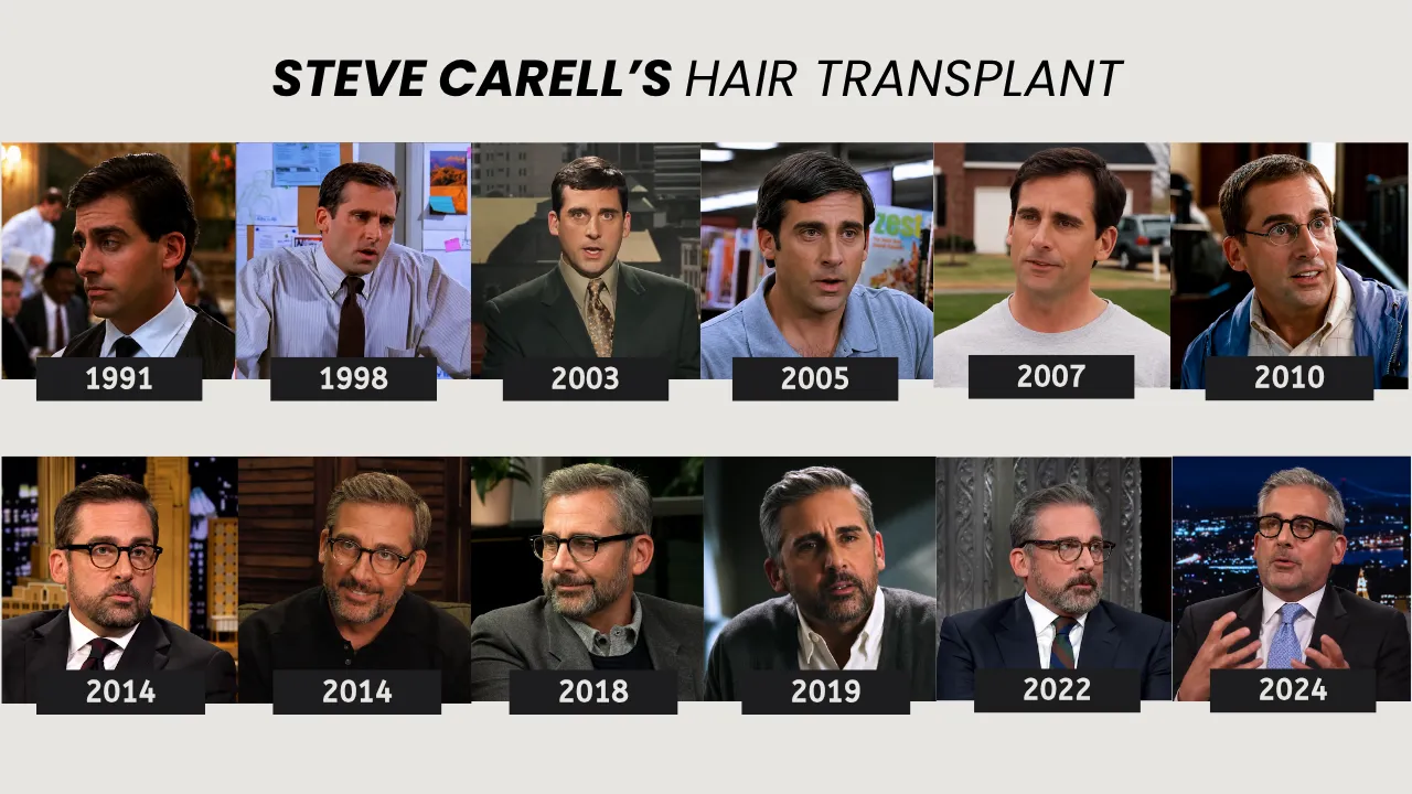 Steve Carell Hair Transplant Timeline 1991 To 2024 Steve Carell Hair Transplant Timeline From 1991 To 2024 Showing Hairline Changes Over Time