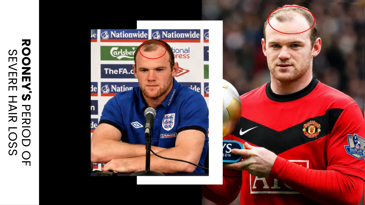 Wayne Rooney Severe Hair Loss Before Hair Transplant Wayne Rooney Severe Hair Loss Period Showing Advanced Frontal Recession Before His Hair Transplant Procedure