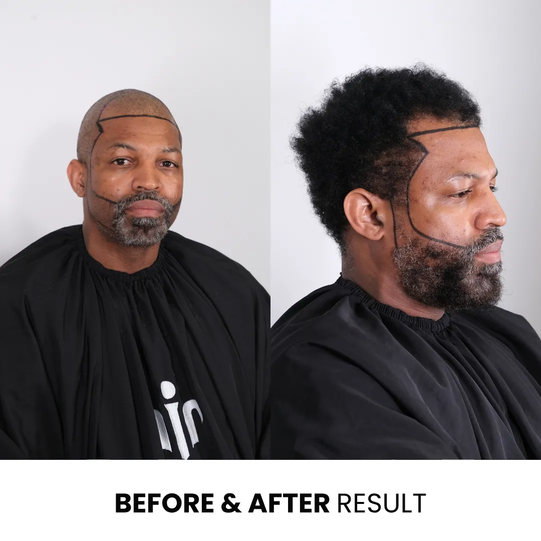 Afro Hair Transplant Cost – Full Breakdown Of Prices, Techniques And Real Results 7 Afro Hair Transplant Before And After Result Showing Hairline Restoration And Treatment Planning