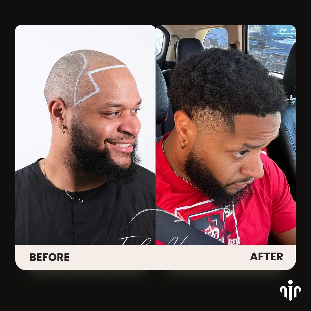 Hair Transplant Recovery Timeline: Day-By-Day, Week-By-Week And Month-By-Month Guide 5 Afro Hair Transplant Before And After Result Showing Restored Frontal Hairline, Temple Coverage, And Natural Curly Hair Density