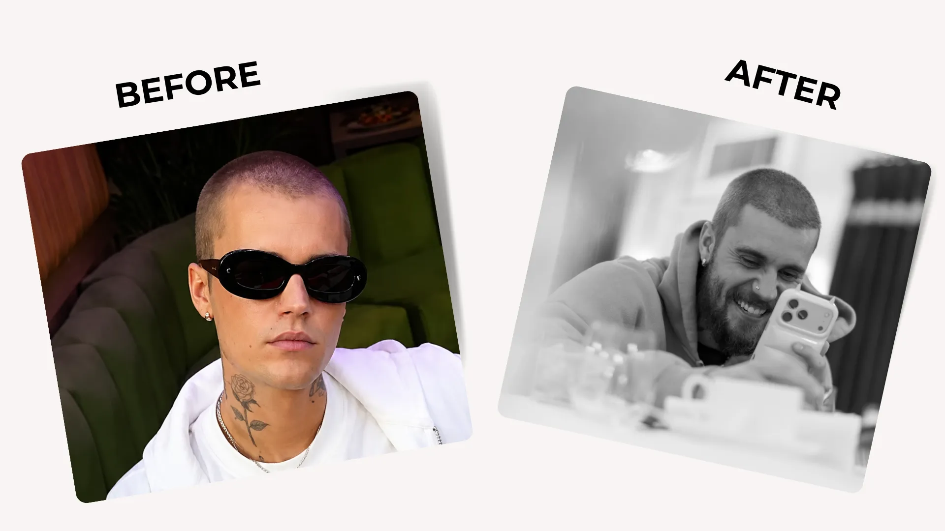 Justin Bieber Hair Transplant: Hairline Analysis, Before &Amp; After Photos, Rumors &Amp; Expert Opinion 11 Justin Bieber Before And After Hairline Comparison Showing Short Buzz Cut Hairstyle, Frontal Hair Coverage, And Visible Hair Change