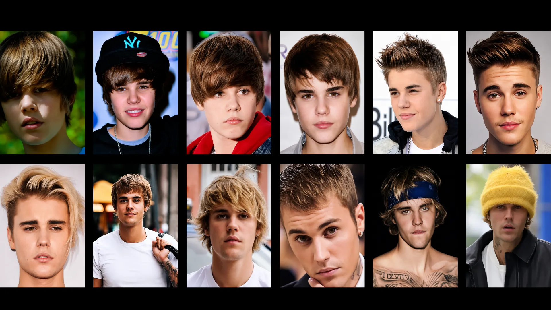 Justin Bieber Hair Transplant: Hairline Analysis, Before &Amp; After Photos, Rumors &Amp; Expert Opinion 4 Justin Bieber Hairstyle Evolution Collage Showing Hairline, Haircut, And Hair Density Changes Over The Years