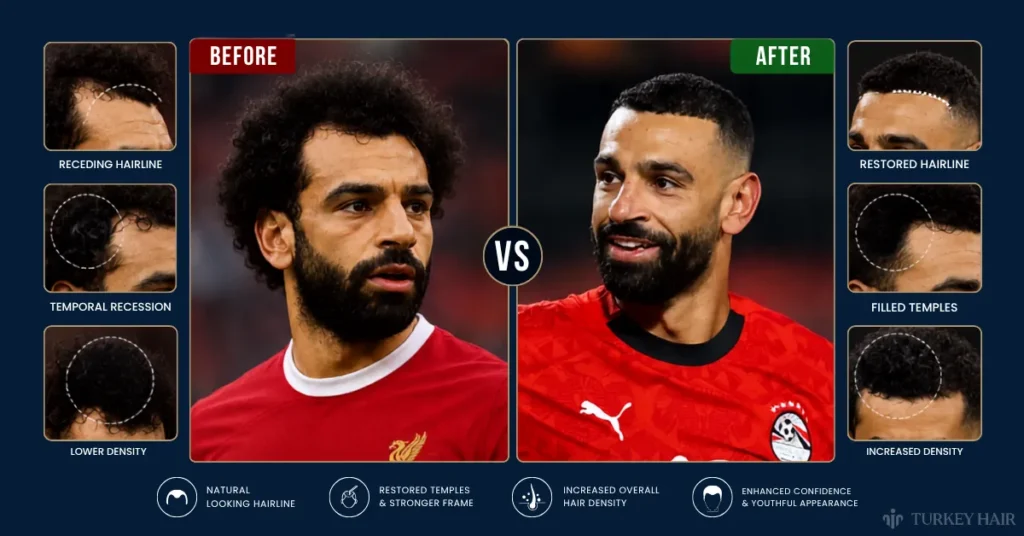 Mohamed Salah Hair Transplant: Before &Amp; After Photos, Graft Count &Amp; Expertanalysis 4 Mohamed Salah Hair Transplant Before After, Mohamed Salah Hair Transplant Results, Did Mohamed Salah Have A Hair Transplant, Mohamed Salah Hairline Restoration, Temple Recession Treatment, Celebrity Hair Transplant Before After, Hair Density Improvement