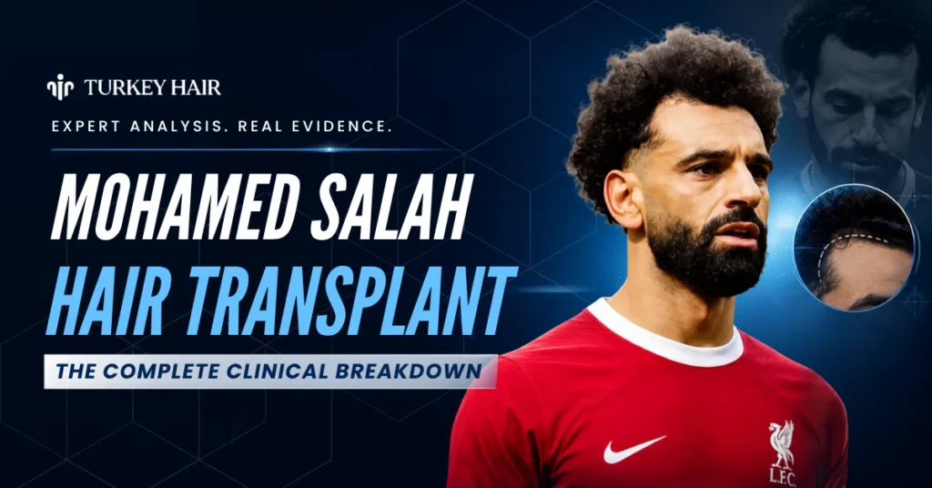 Mohamed Salah Hair Transplant: Before &Amp; After Photos, Graft Count &Amp; Expertanalysis 1 Mohamed Salah Hair Transplant, Did Mohamed Salah Get A Hair Transplant, Mohamed Salah Hairline, Mohamed Salah Before After, Celebrity Hair Transplant, Footballer Hair Transplant, Mohamed Salah Hair Restoration, Turkey Hair Center Analysis