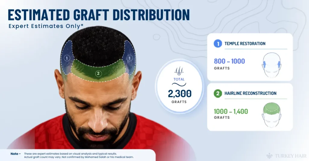 Mohamed Salah Hair Transplant: Before &Amp; After Photos, Graft Count &Amp; Expertanalysis 5 Mohamed Salah Hair Transplant Grafts, How Many Grafts Did Mohamed Salah Get, Mohamed Salah Graft Count, Hairline Reconstruction Grafts, Temple Restoration Grafts, Fue Graft Distribution, Celebrity Hair Transplant Graft Estimate