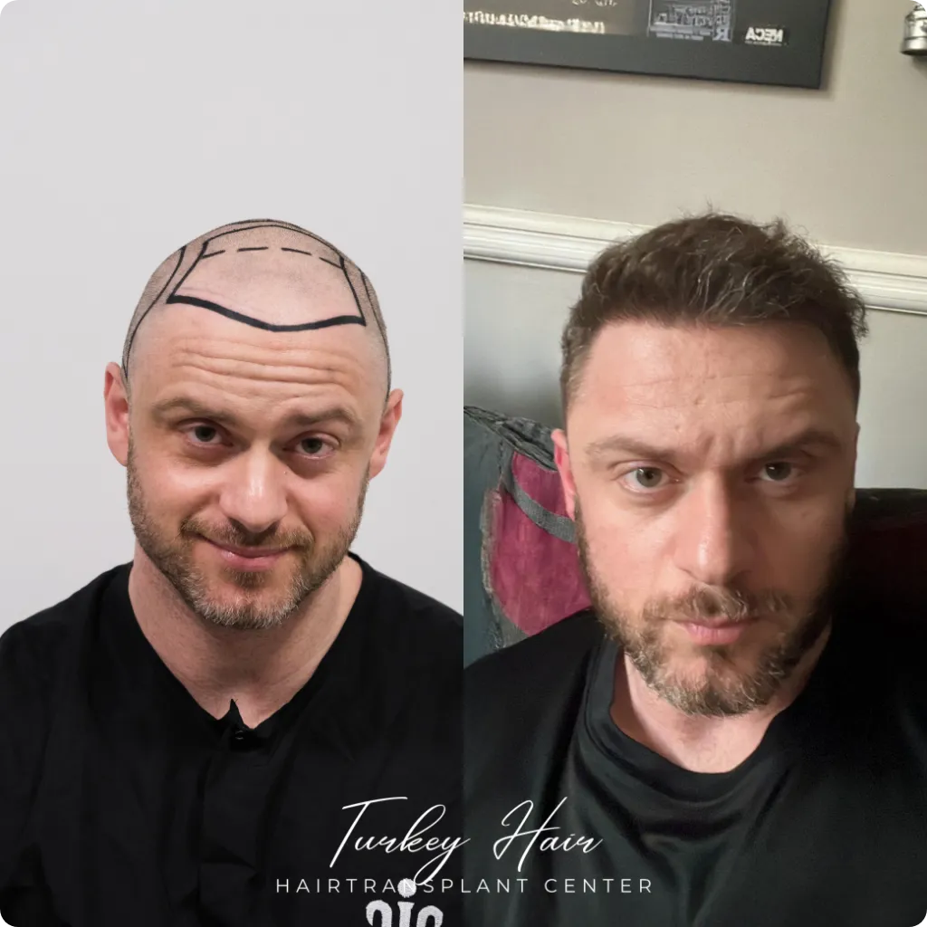 Hair transplant before and after result showing restored hairline and increased hair density in Turkey