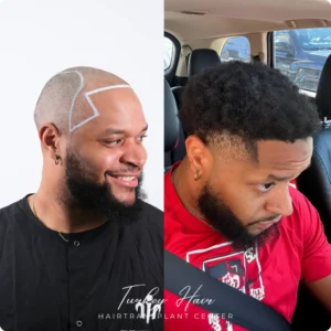 Afro Hair Transplant Before And After Result Showing Natural Hairline Restoration in Ethiopia
