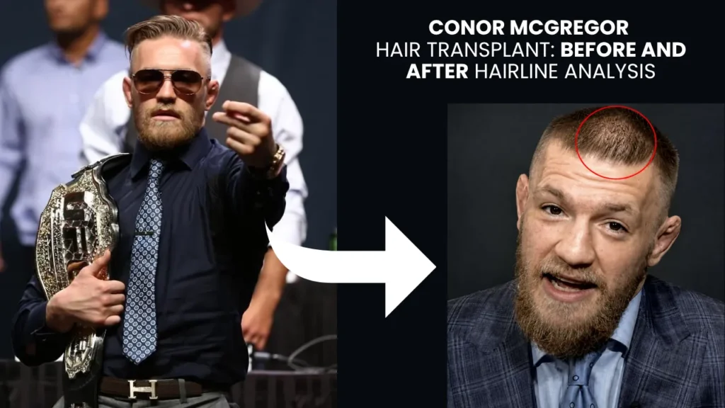Conor Mcgregor Hair Transplant: Before &Amp; After 3 Conor Mcgregor Hair Transplant Before And After Hairline Restoration Analysis