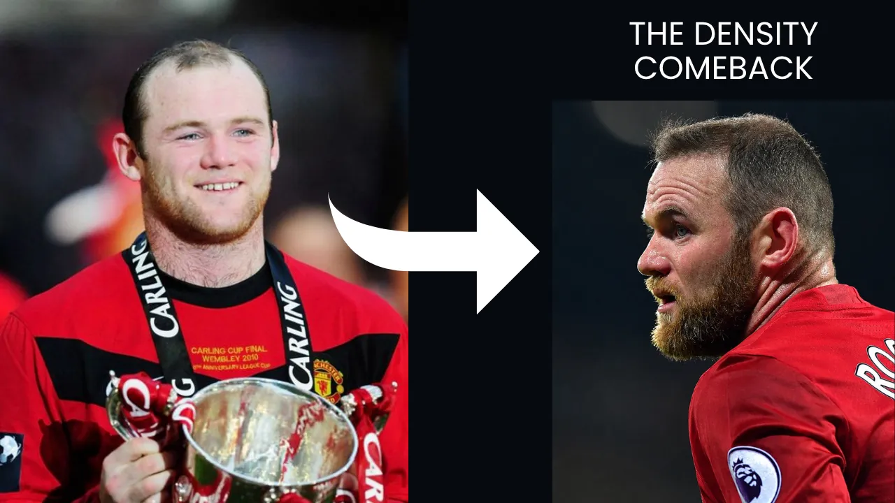 Wayne Rooney Hair Transplant: Before &Amp; After 5 Wayne Rooney Hair Transplant Before And After Comparison Showing Improved Hair Density And Restored Hairline