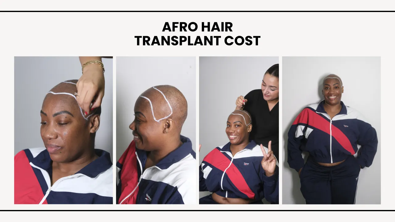 Afro Hair Transplant Cost – Full Breakdown Of Prices, Techniques And Real Results 10 Afro Hair Transplant Cost In Turkey With Female Patient Consultation And Hairline Design