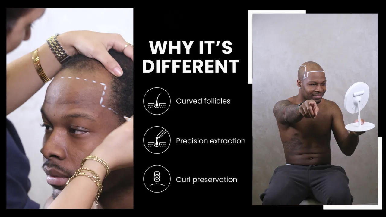Afro Hair Transplant Cost – Full Breakdown Of Prices, Techniques And Real Results 12 Afro Hair Transplant Procedure Showing Hairline Design And Curl-Preserving Technique