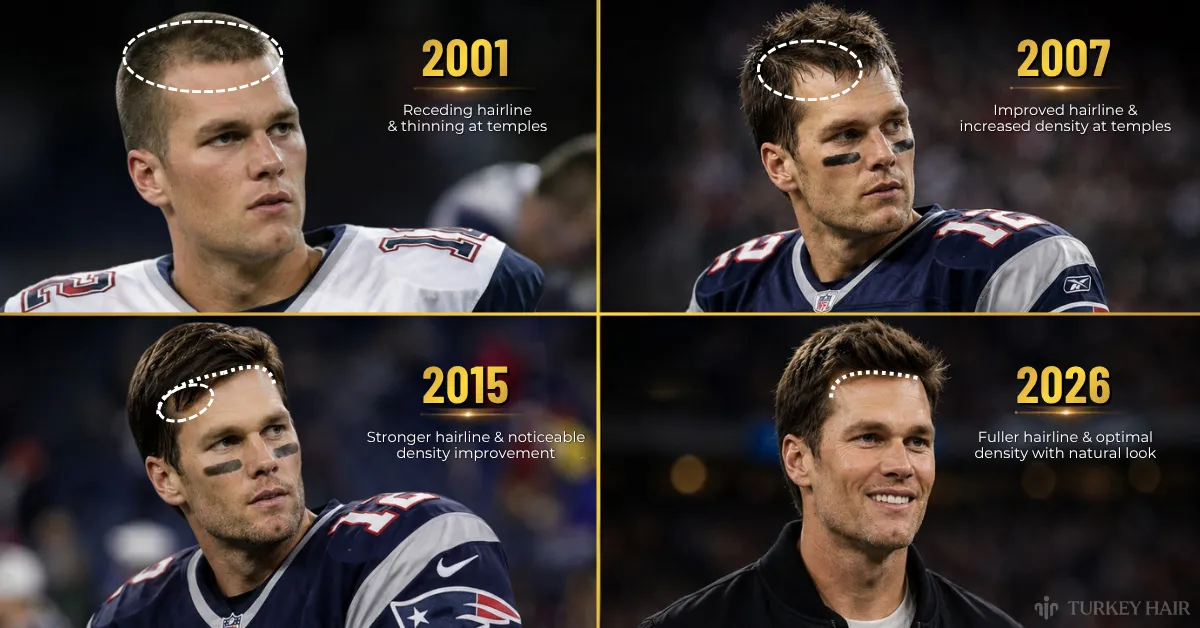 Tom Brady Hair Transplant: Before &Amp; After Photos, Hairline Analysis, Rumors Vs Facts 2 Om Brady Hair Transplant Timeline, Tom Brady Hair 2001 Vs 2026, Did Tom Brady Lose His Hair, Tom Brady Hairline Over The Years, Tom Brady Hair Transformation